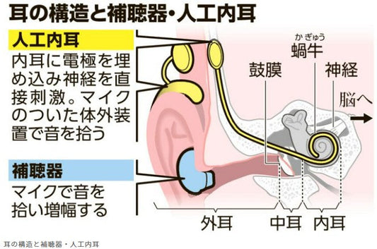 1千人に1~2人の先天性難聴 検査普及で早期治療 支援機器も進歩
