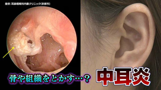 「プールで耳に水が入って中耳炎」間違い?!大人も要注意…放置すると危険な“中耳炎” 骨や組織を溶かすことも