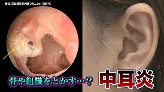 「徐々に周りの骨を溶かして…」放っておくと危険な “中耳炎”　子どもから大人まで年間約27万人が罹患
