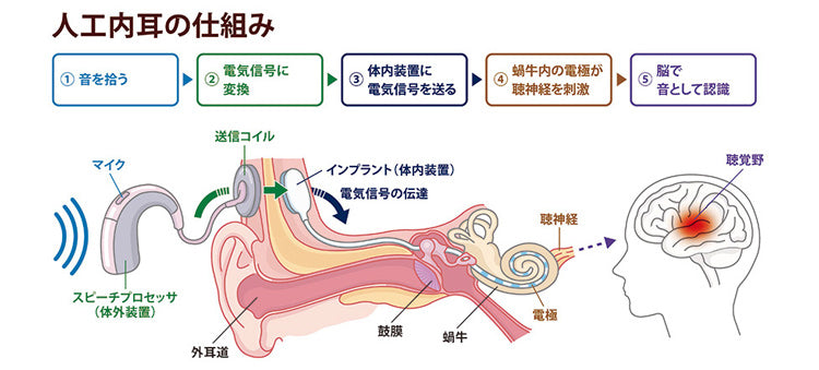 人工内耳の仕組み（本田財団提供）