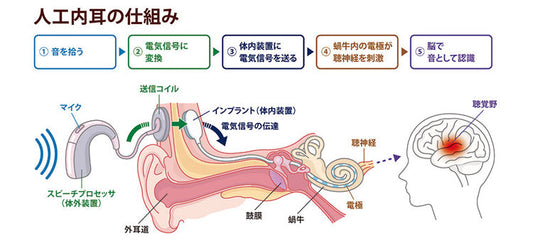 人工内耳の仕組み（本田財団提供）