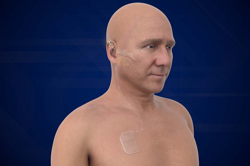 MUSC、完全に皮下に埋め込まれた人工内耳の臨床試験を主導へ