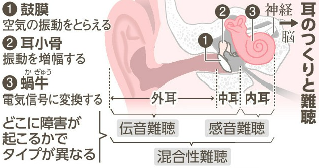 補聴器で聞こえない重い難聴、人工内耳の選択肢　術後リハビリも大切
