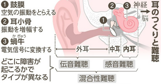 補聴器で聞こえない重い難聴、人工内耳の選択肢　術後リハビリも大切
