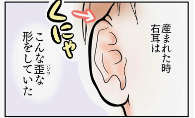 埋没耳のイラスト