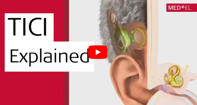 YouTube動画画像「MED-EL社、初の完全埋め込み型人工内耳「TICI UNICO」を発表」