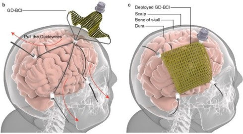 「脳を覆う電極シート」、香港チームが開発　数ミリの穴から挿入し展開　ビーグル犬で検証、術後1日で退院